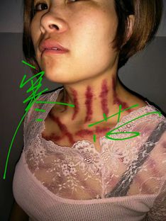 杭州寒芯揪痧老师图片 - 杭州寒芯揪痧老师直播间 - 美女视频聊天交友