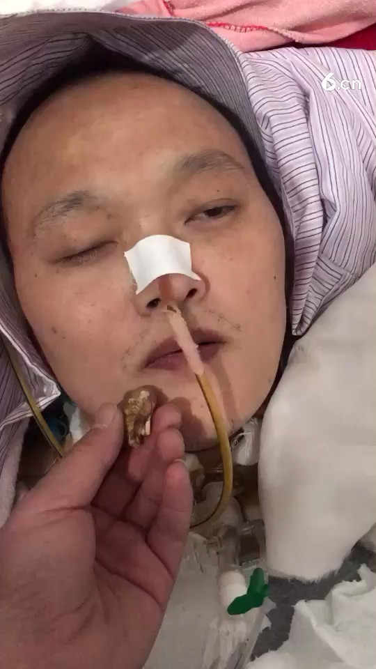 重度昏迷第38天 已经可以进食